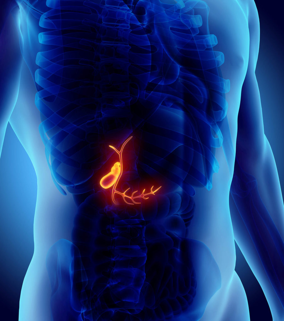 Do Gallstones Lead To Pancreatic Cancer